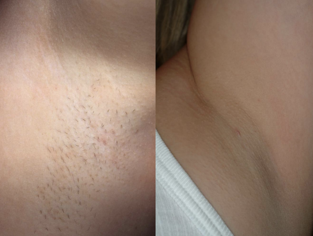 Antes y despues depilacion corporal